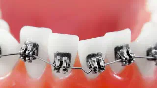 Illustration for How Can We Correct Crooked Teeth?