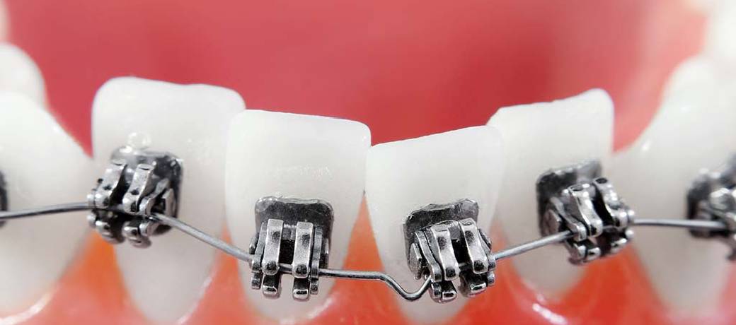 How Can We Correct Crooked Teeth?