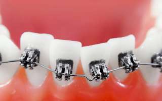 How Can We Correct Crooked Teeth?