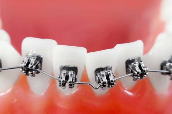 A closeup of dental braces