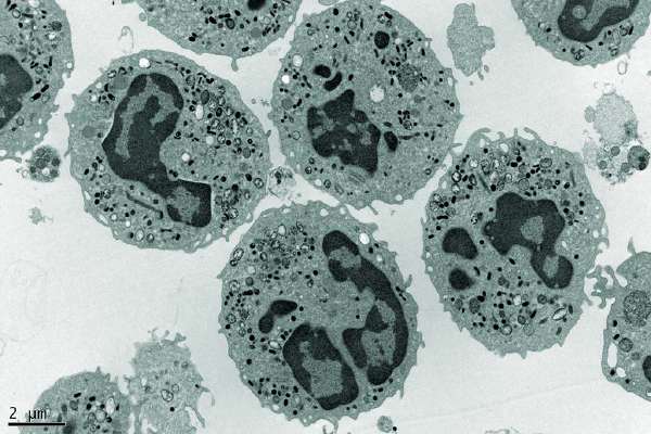 Electron Microscopy Photography of a group of human Neutrophils. Acute myeloid leukemia (AML) is a disorder of the process that normally produces neutrophils, a type of white blood cell