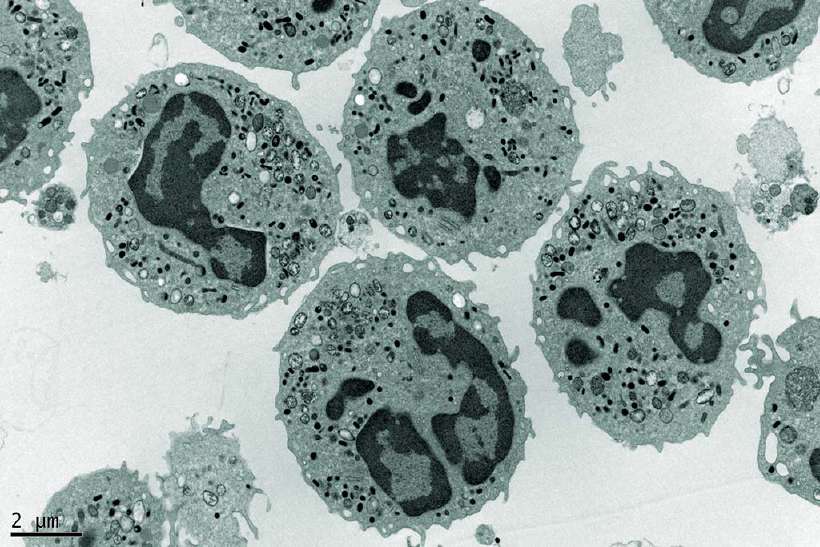 Electron Microscopy Photography of a group of human Neutrophils. Acute myeloid leukemia (AML) is a disorder of the process that normally produces neutrophils, a type of white blood cell