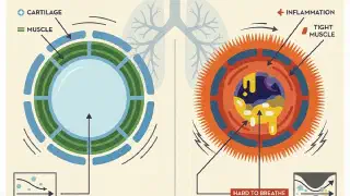 Illustration for What is Asthma?